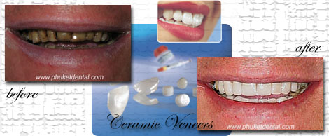 Ceramic/Porcelain Veneers by Phuket Dentist at Phuket Dental Clinic in Phuket,Thailand