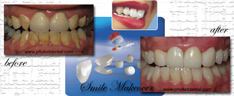 http://www.phuketdental.com/pictures_clinical%20cases/01%20smile%20makeover/smile_makeover02.jpg