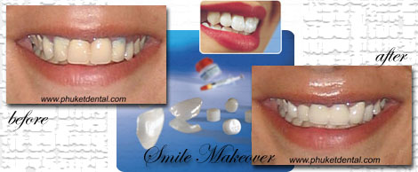 Smile Makeovers by Phuket Dentist at Phuket Dental Clinic in Phuket,Thailand