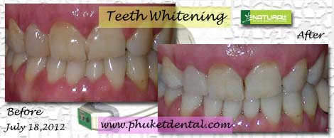 Tooth Whitening:non-LASER,LED,Natural Plus at Phuket Dental Clinic,Thailand