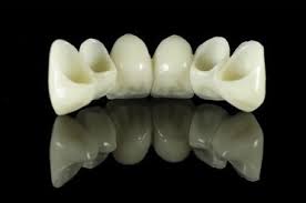 all ceramic bridge