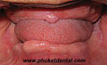 Complete Denture/Full Denture at Phuket Dental Clinic,Thailand