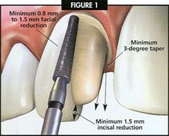 dental crown