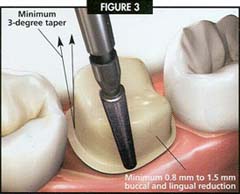 dental crown