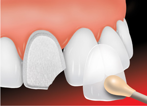 dental veneers:Phuket dentist