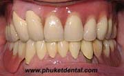 Partial Dentures with Telescope Crown Attachment