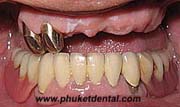 Partial Dentures with Telescope Crown Attachment