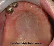 Partial Dentures with Telescope Crown Attachment