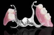 vitallium partial denture:Phuket Dental clinic,Thailand